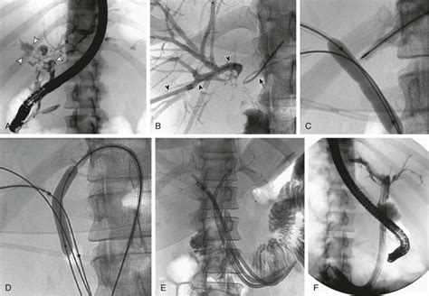 b4il3e leaks|Current Management of Biliary Leaks